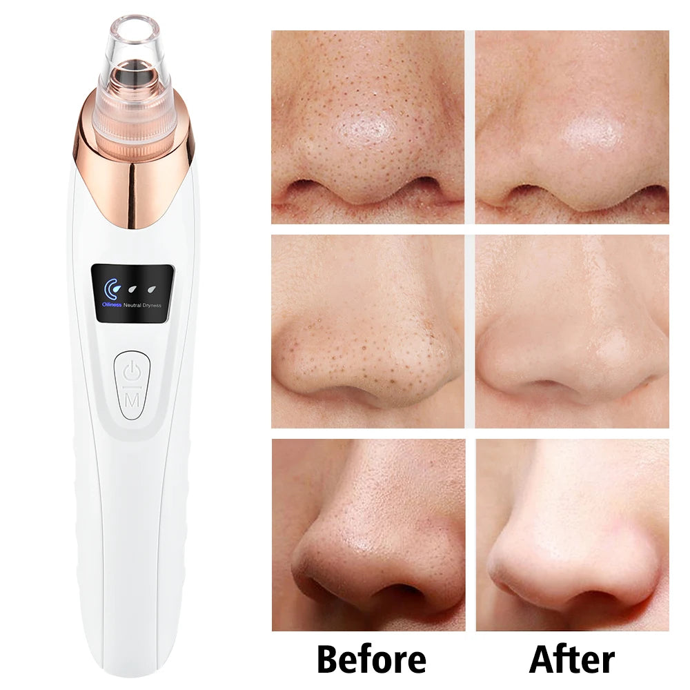 Blackhead Remover Vacuum Suction USB Rechargeable Facial Pore Cleaner