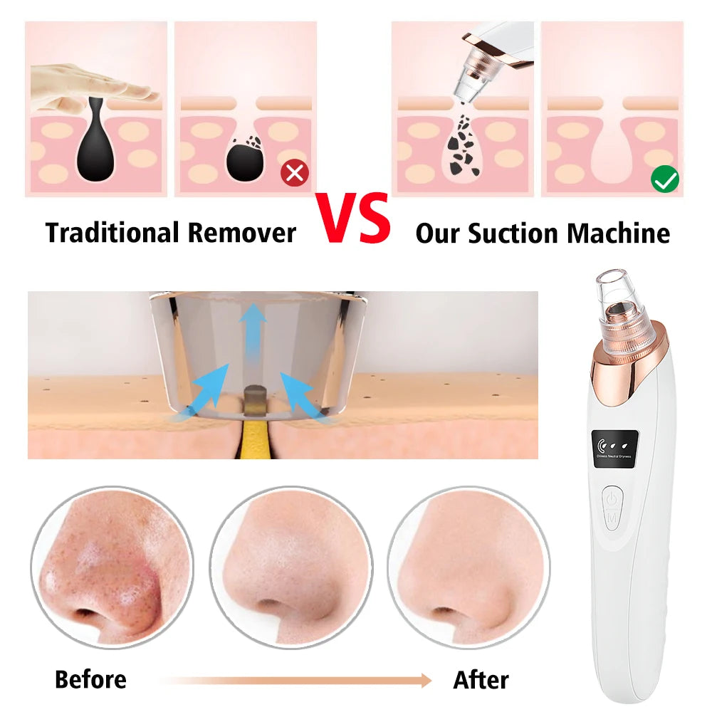 Blackhead Remover Vacuum Suction USB Rechargeable Facial Pore Cleaner